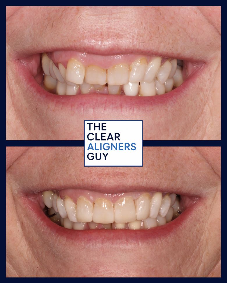 Clear aligner result 1