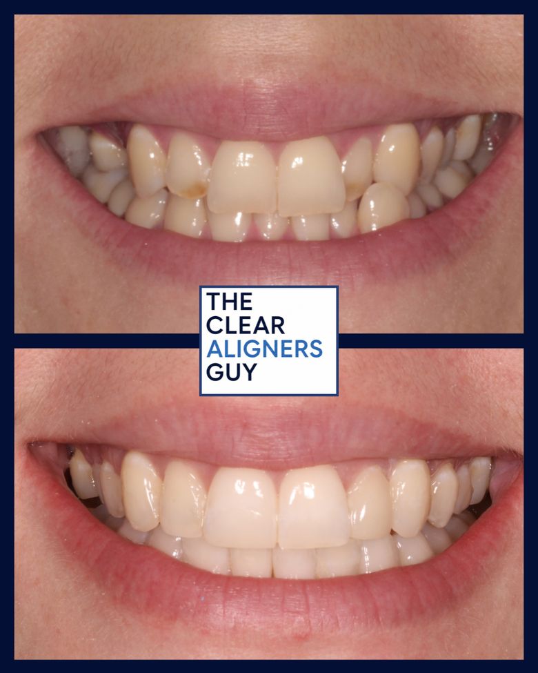 Clear aligner result 2
