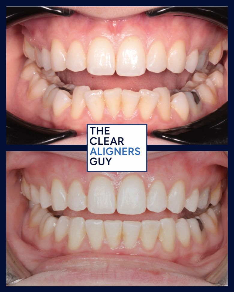 Clear aligner result 3